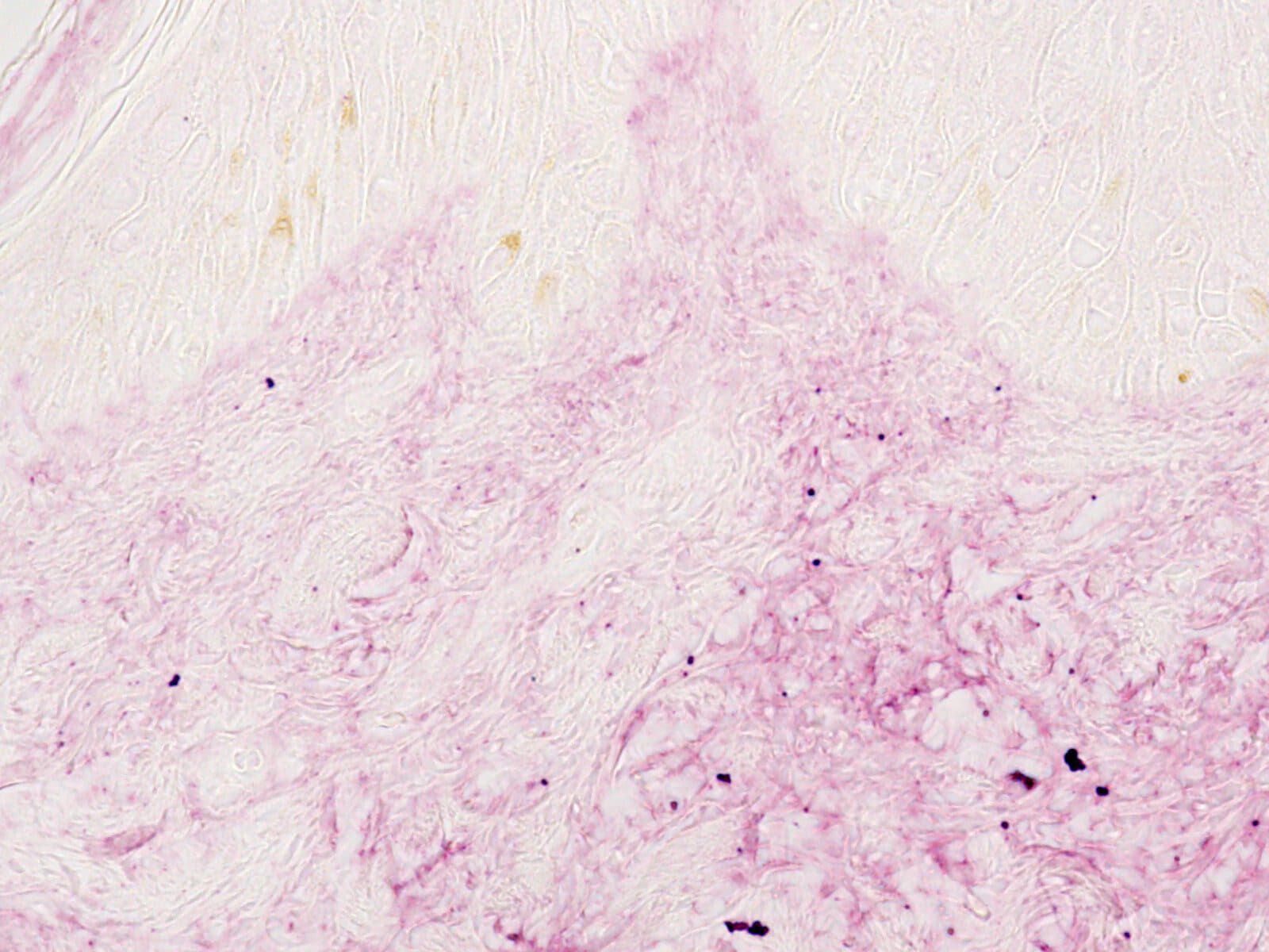 Scientific analysis of glycated skin tissue showing compromised collagen fibers. 