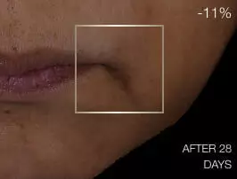 Close-up of skin before treatment, showing visible nasolabial folds and signs of aging around the mouth.