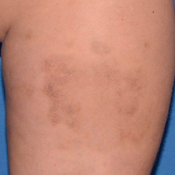 Day 28 with reference cream